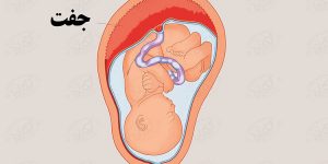 انواع جفت در دوران بارداری